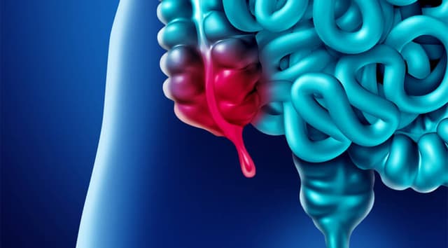 Apendicitis aguda