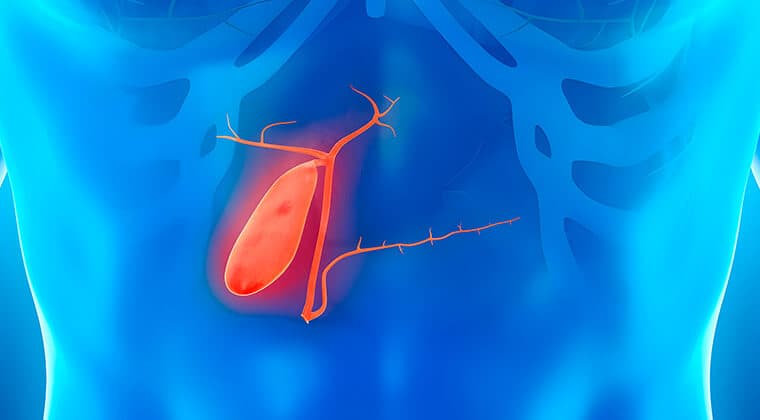 Colecistitis aguda/litiasis biliar