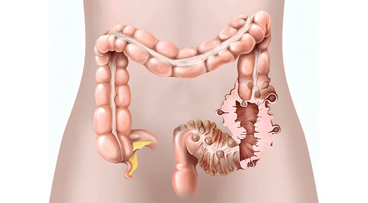 Diverticulitis complicada (absceso, perforación)