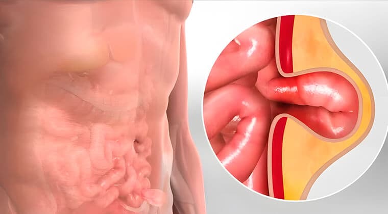 Hernias abdominales (inguinal, umbilical, incisional)