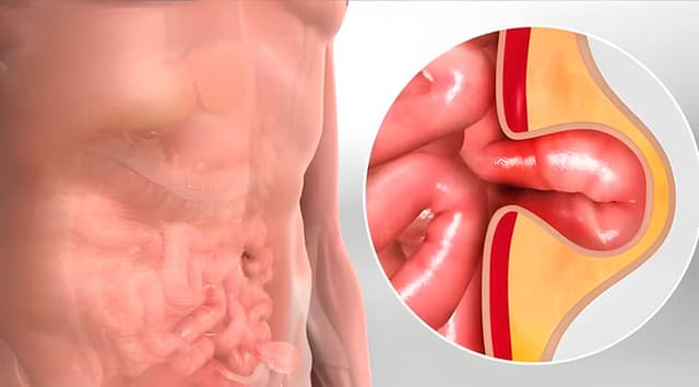Hernias abdominales (inguinal, umbilical, incisional)