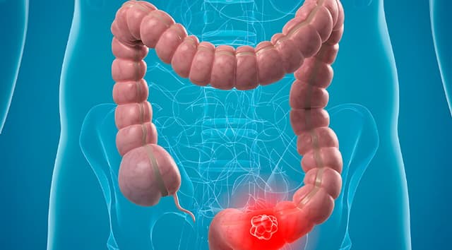 Neoplasias gastrointestinales (cáncer gástrico, colorrectal)
