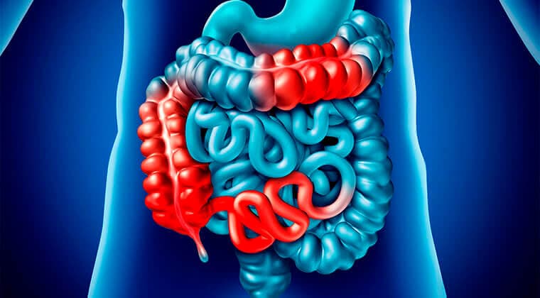 Obstrucción intestinal (adherencias, tumores, hernia interna)