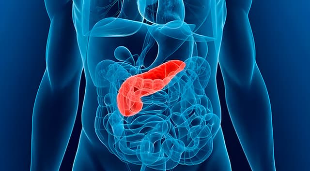 Pancreatitis aguda grave (con necrosis infectada)