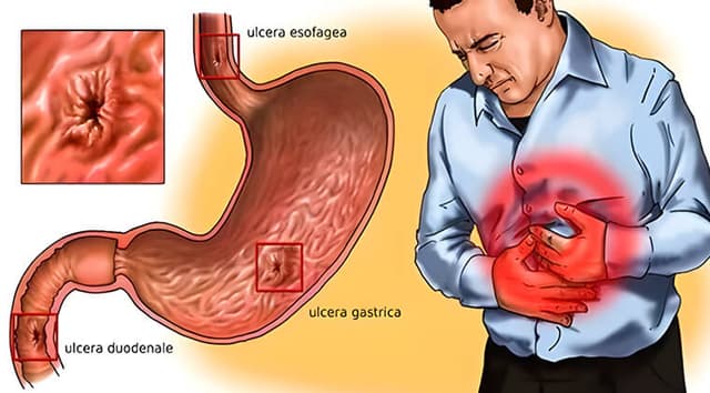 Úlcera péptica complicada (perforación, sangrado)